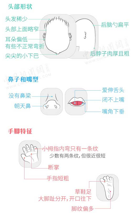 世界唐氏综合征日 一图科普唐氏儿