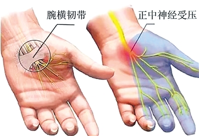 <p>　　腕管综合征症状图。（资料图片）</p>