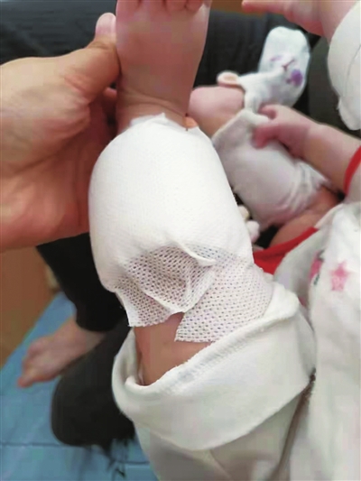银川市仅半岁的女婴做艾灸深二度烫伤