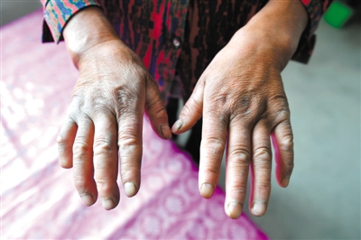 <p>　　李耀梅的双手布满伤疤、老茧，右手小拇指也有残缺。这双手3年扎制出2.5万把扫帚，不仅供女儿上了大学，而且还清了因看病欠下的30万元“情义外债”。</p>